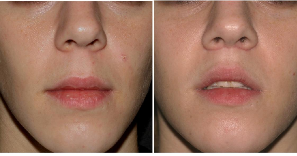 Lip Flip Before and After